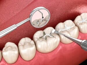 dental sealants plano