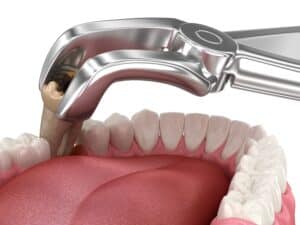bad breath after tooth extraction
